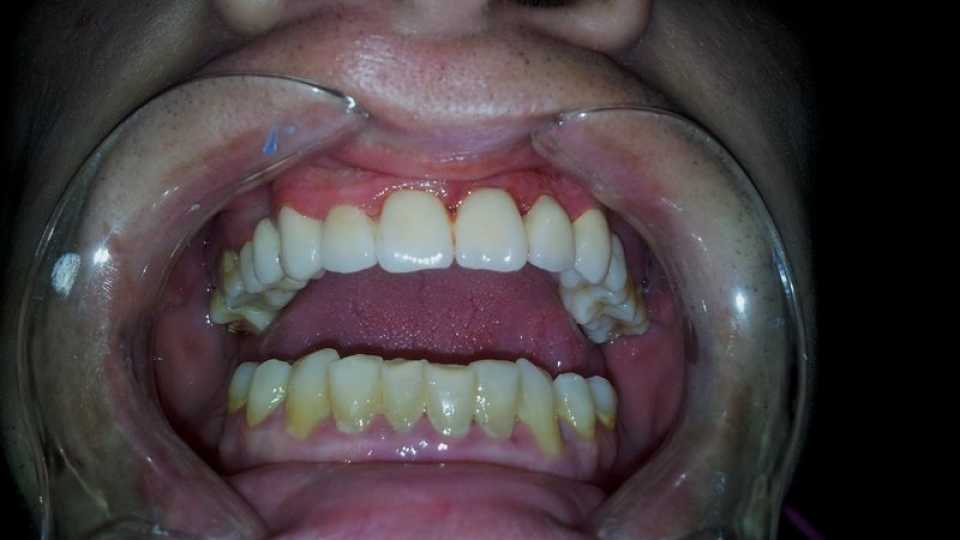 Punte dentara din ceramică Vita pe structură metalică