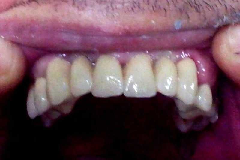 Punți dentare