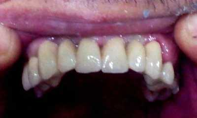 Punți dentare