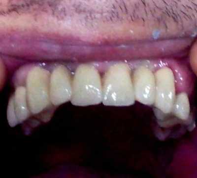 Punți dentare