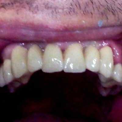 Punți dentare