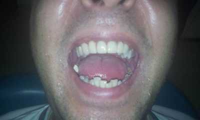 Punte dentară fixă de Zirconiu