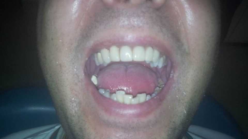 Punte dentară fixă de Zirconiu