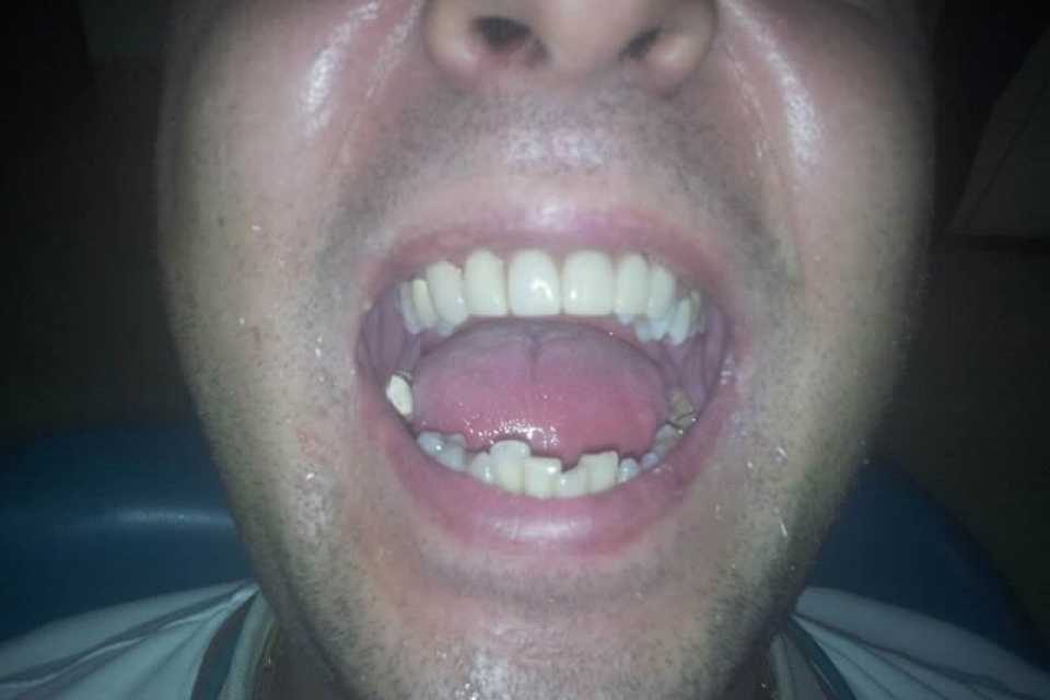 Punte dentară fixă de Zirconiu