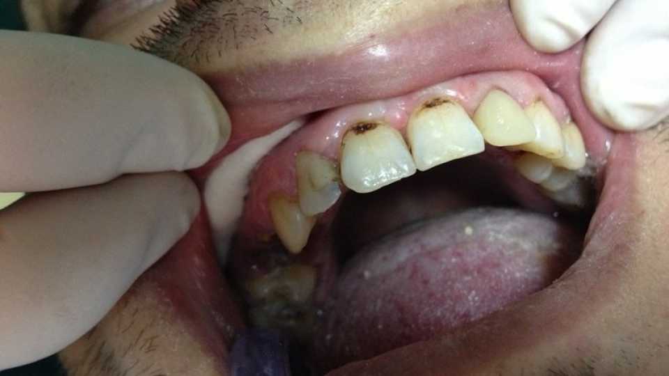 Reconstituire extemporanee pivot fibră de sticlă