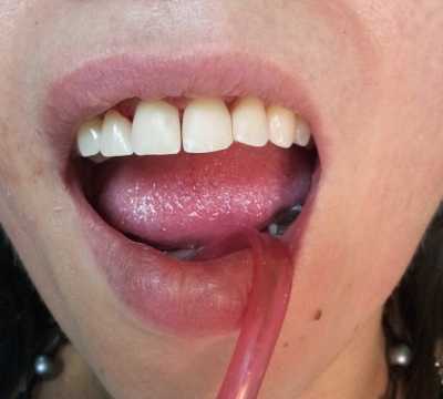 Reconstituire obturații compozit zona frontala