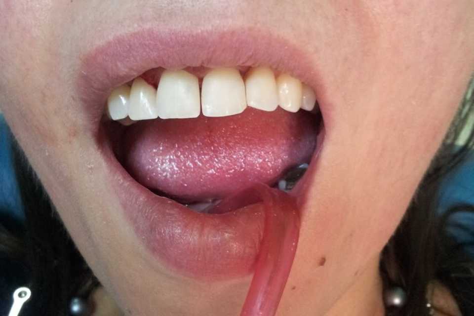 Reconstituire obturații compozit zona frontala