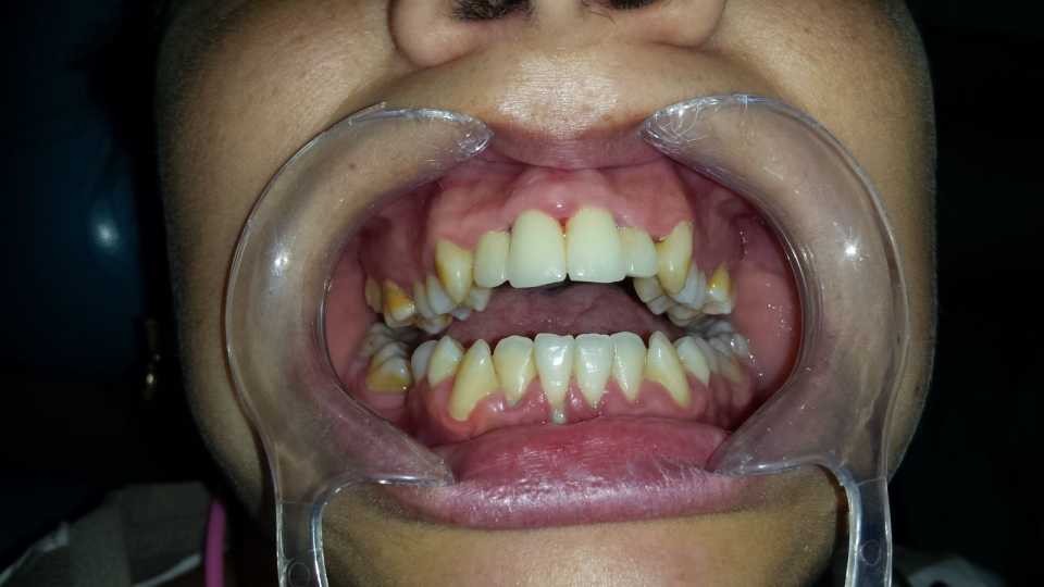 Refacere tratamente și coroană metalo-ceramică