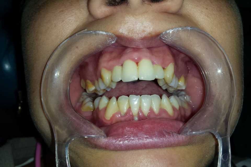 Refacere tratamente și coroană metalo-ceramică