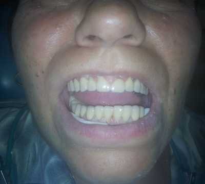 Punți totale superioare și inferioare