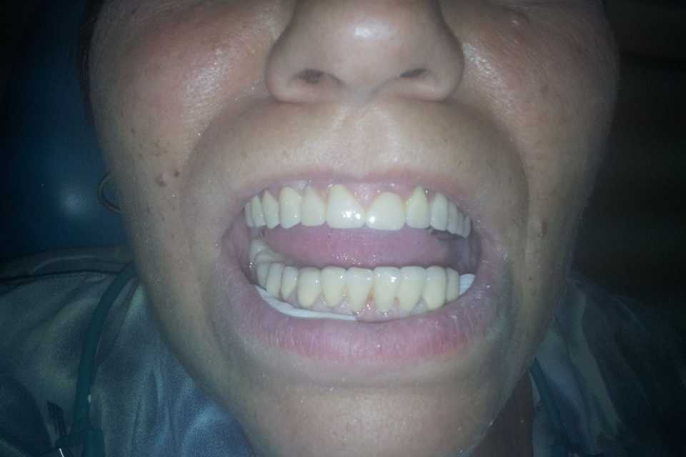 Punți totale superioare și inferioare