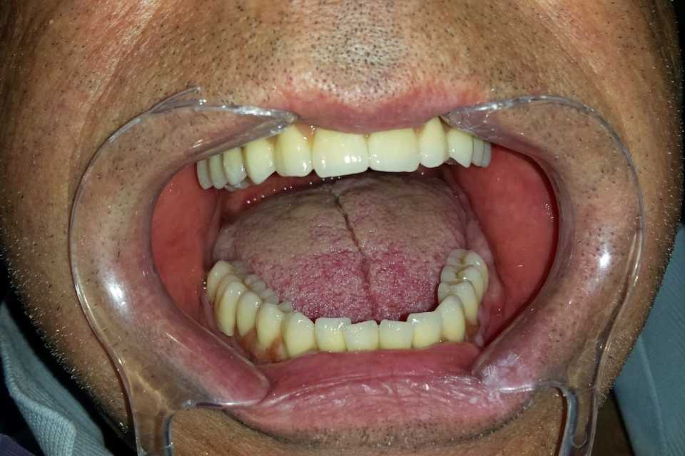 Edentație totală bimaxilară