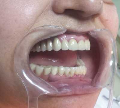 Punte metalo-ceramică superior și scheletată inferior