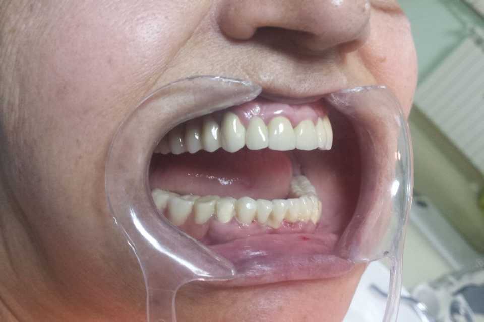 Punte metalo-ceramică superior și scheletată inferior