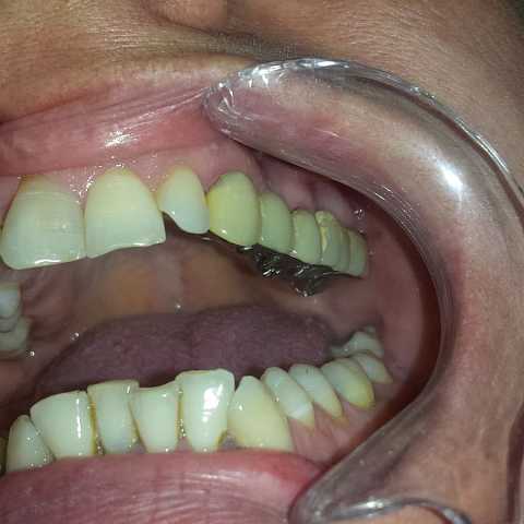 Punte dentară metalo-ceramică