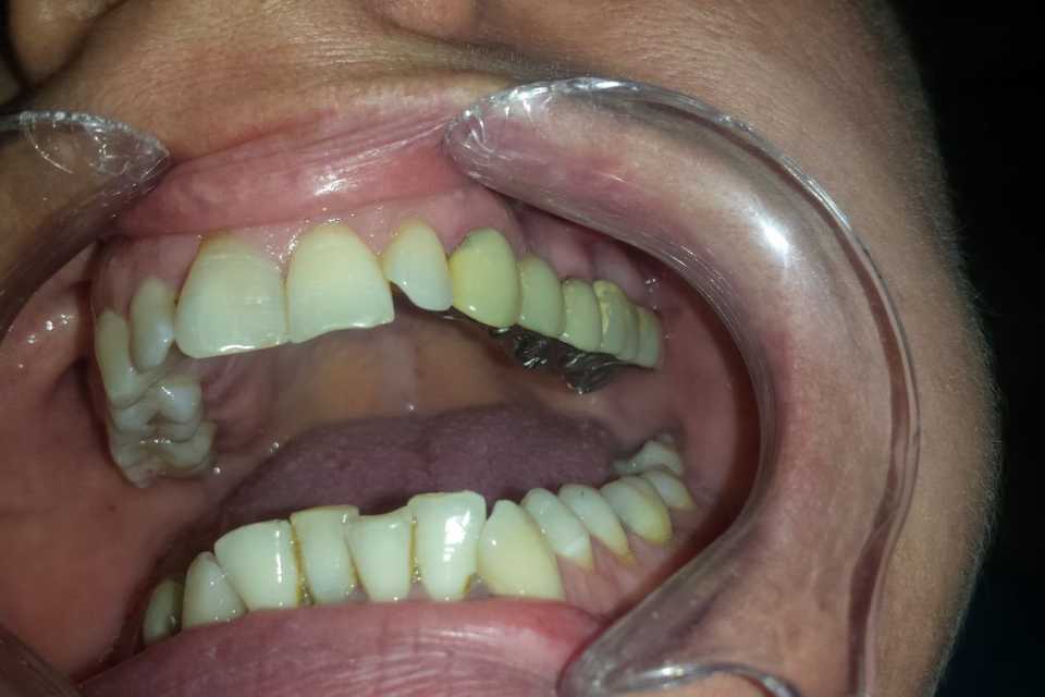 Punte dentară metalo-ceramică