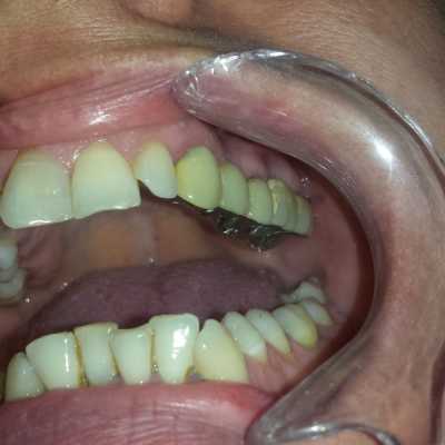 Punte dentară metalo-ceramică