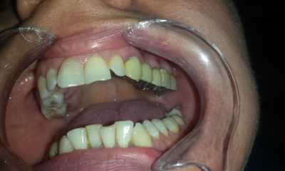 Punte dentară metalo-ceramică
