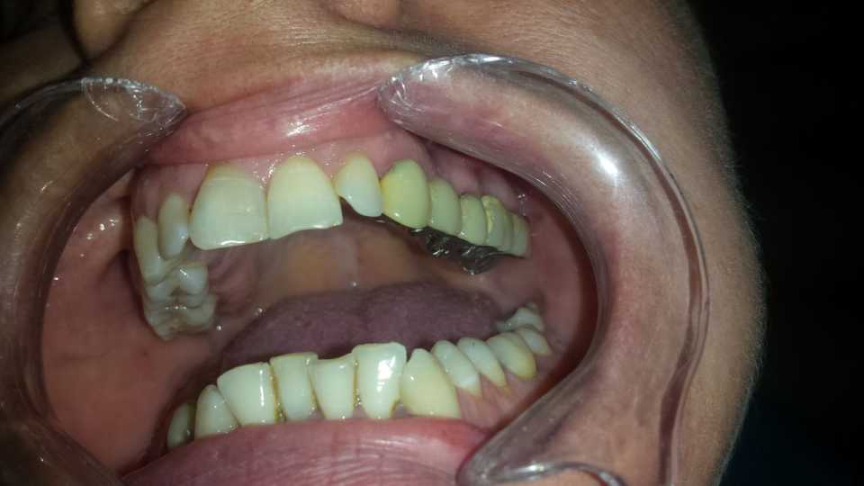 Punte dentară metalo-ceramică