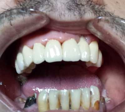 Protezare cu punte fixă metalo-ceramică