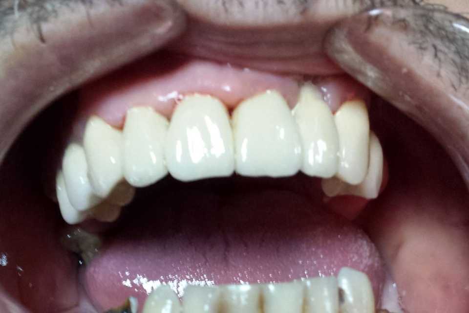 Protezare cu punte fixă metalo-ceramică