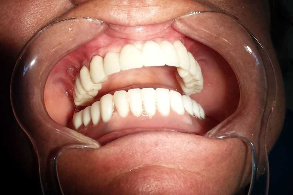 Implanturi Alpha Bio și punte pe suport de Zirconiu