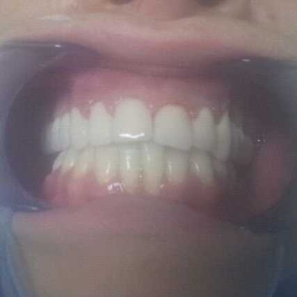 Coroane dentare metalo-ceramice