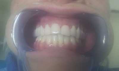 Coroane dentare metalo-ceramice