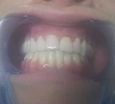 Coroane dentare metalo-ceramice