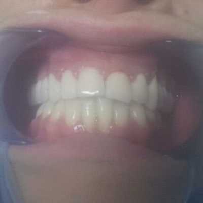 Coroane dentare metalo-ceramice