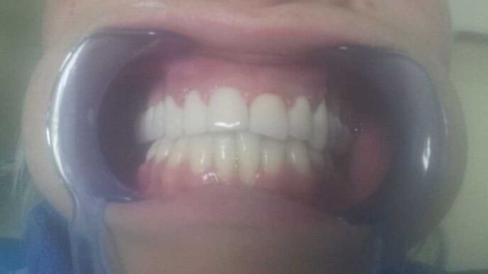 Coroane dentare metalo-ceramice