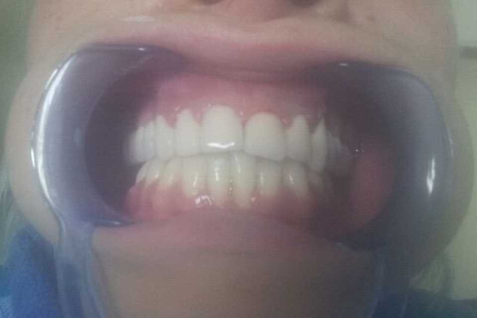 Coroane dentare metalo-ceramice