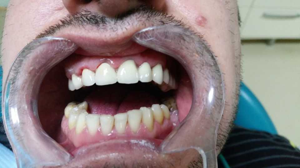 Coroană dentară fixă metalo-ceramică