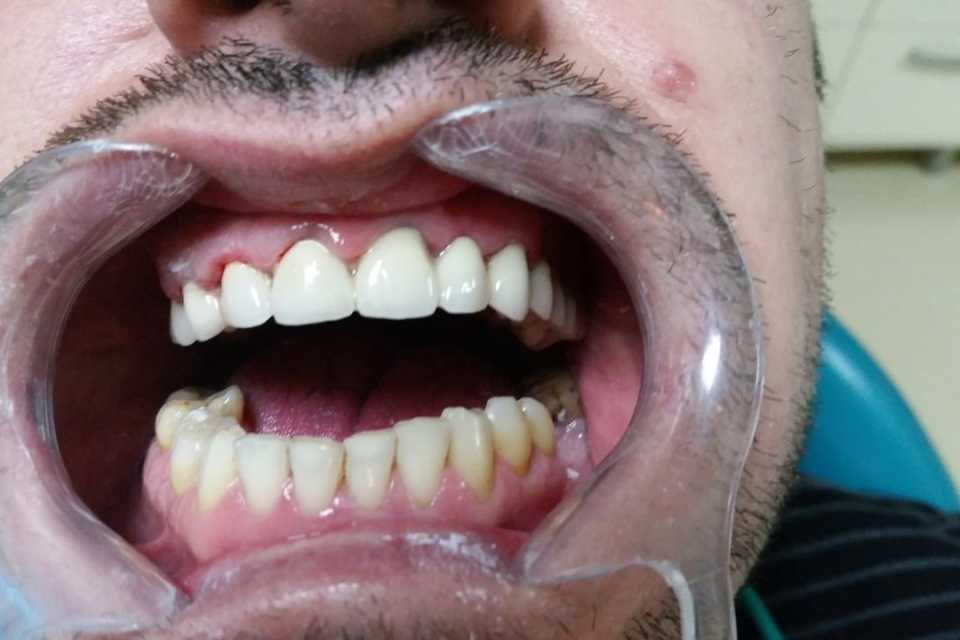 Coroană dentară fixă metalo-ceramică