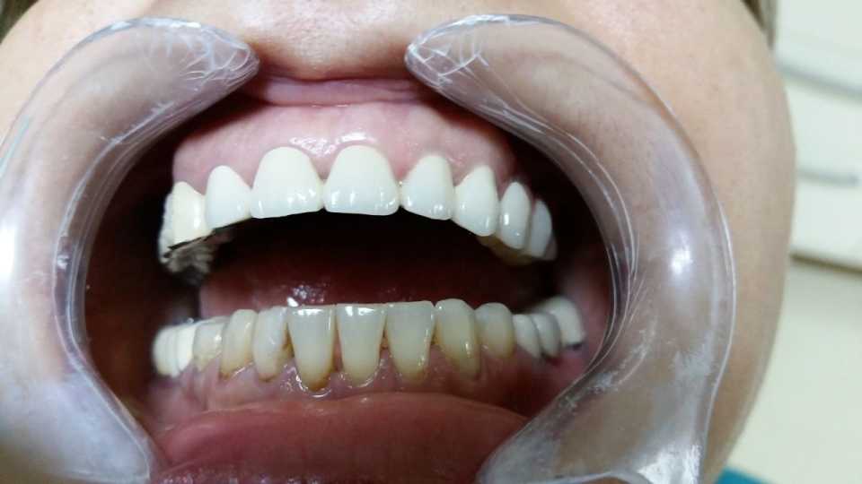 Protezare dinți frontali superiori cu lucrare ceramică