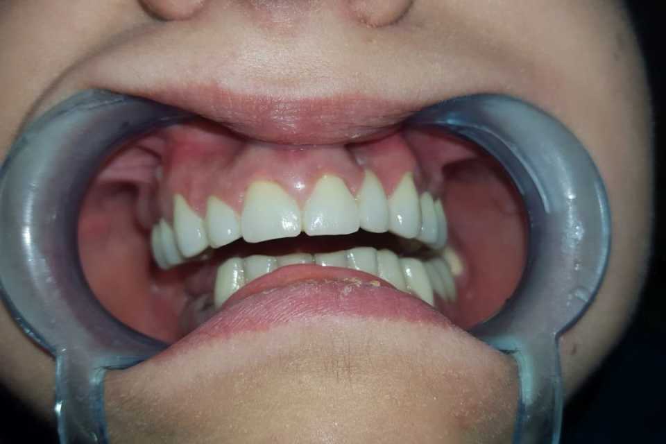 Lucrare metalo-ceramică (design)