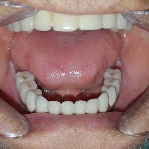 Lucrare protetică fixă: 8 implanturi și protezare
