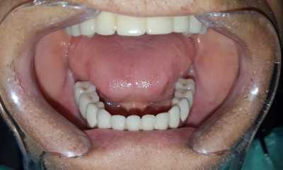 Lucrare protetică fixă: 8 implanturi și protezare