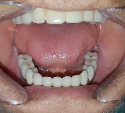 Lucrare protetică fixă: 8 implanturi și protezare