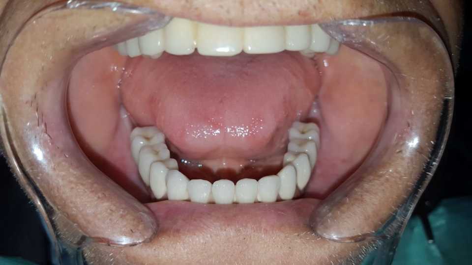 Lucrare protetică fixă: 8 implanturi și protezare