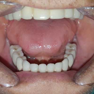 Lucrare protetică fixă: 8 implanturi și protezare