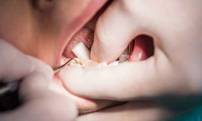 Ce facem în cazul unui dinte spart (fracturi dentare)?