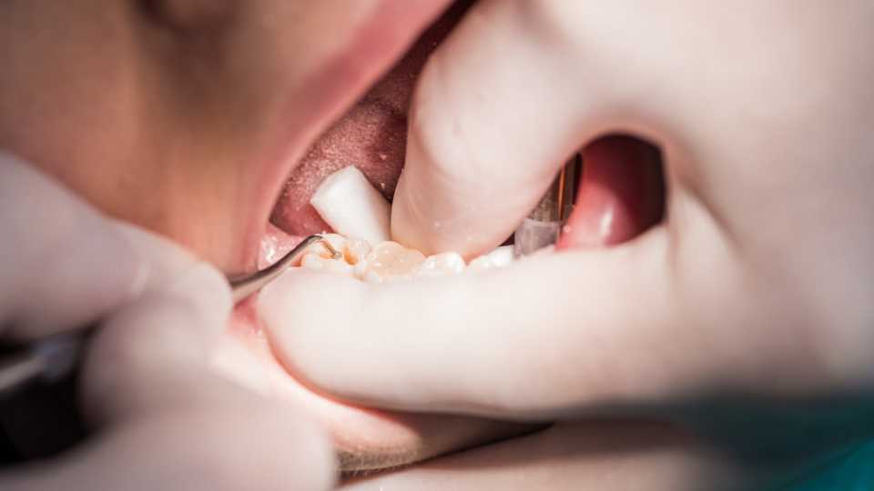Ce facem în cazul unui dinte spart (fracturi dentare)?