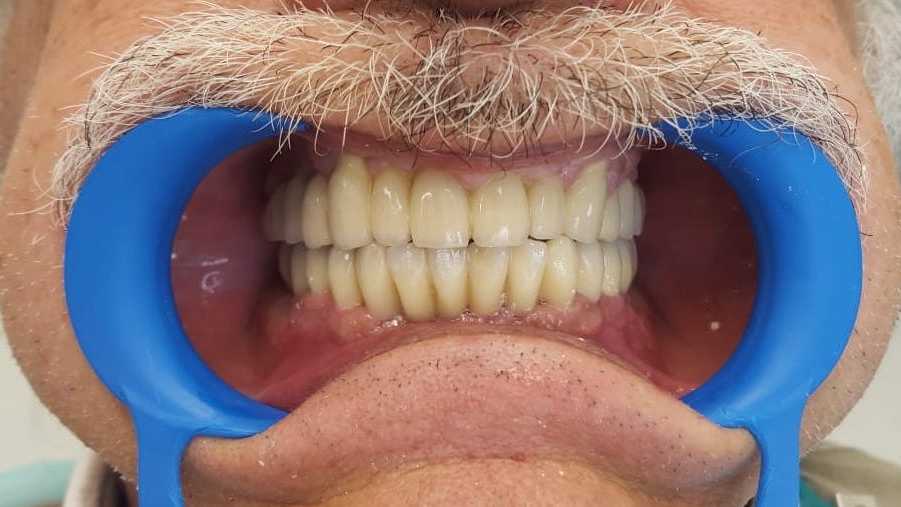 Protezare fixă cu ajutorul implanturilor dentare