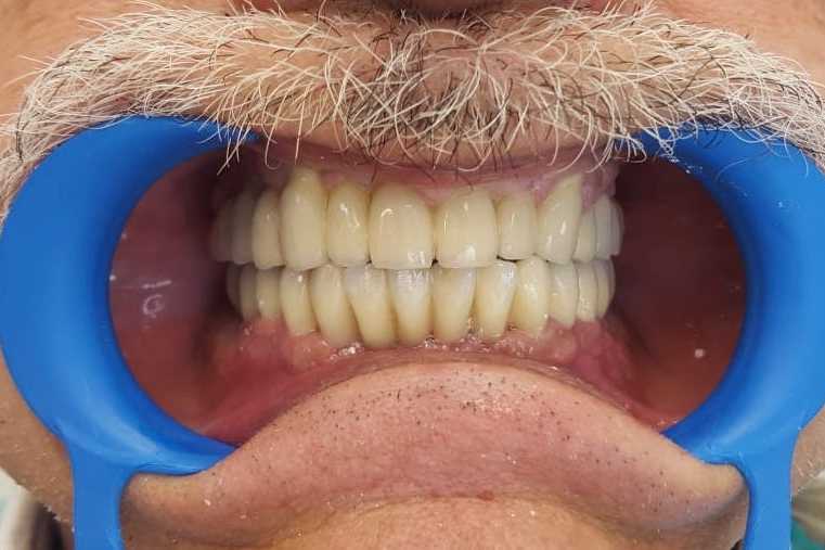Protezare fixă cu ajutorul implanturilor dentare