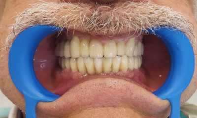 Protezare fixă cu ajutorul implanturilor dentare