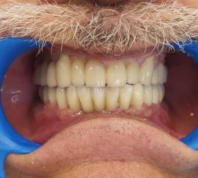 Protezare fixă cu ajutorul implanturilor dentare