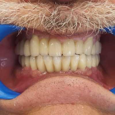 Protezare fixă cu ajutorul implanturilor dentare