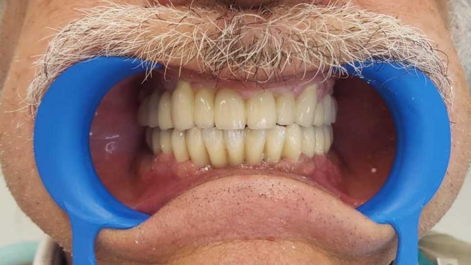 Protezare fixă cu ajutorul implanturilor dentare