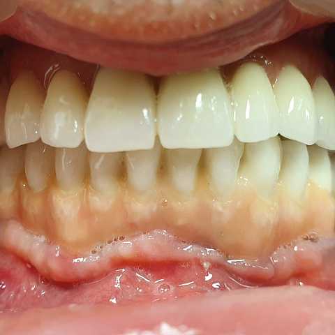 Sinus lifting, implanturi și adiții osoase